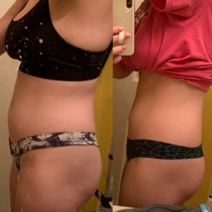 lipo c before and after photo