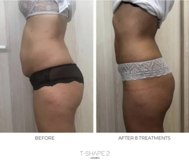 Side profile before and after eight T-Shape 2 treatments showing a flatter, more contoured midsection.