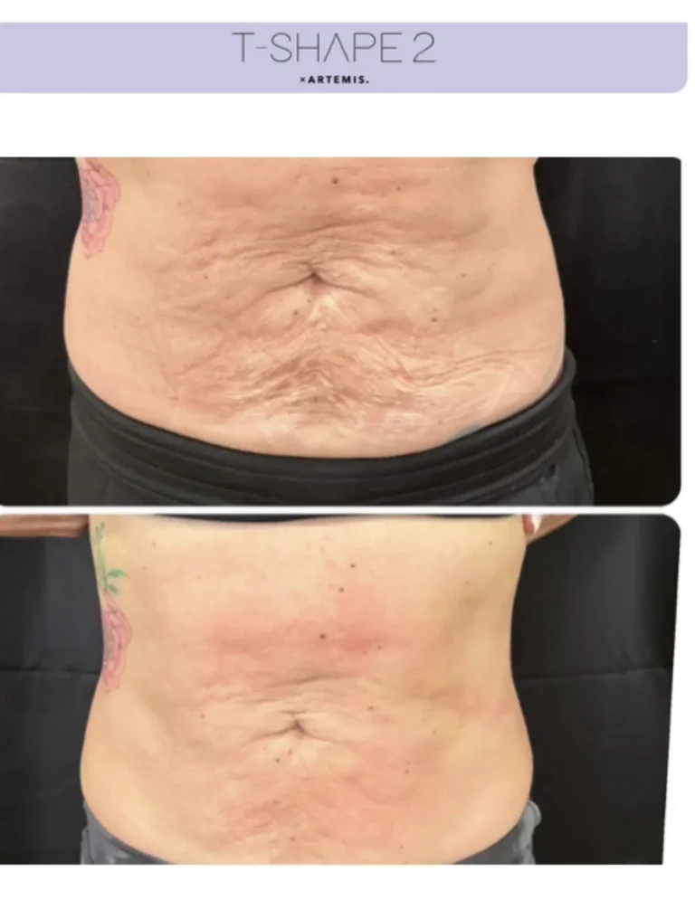 T-Shape 2 before and after showing significantly smoother, firmer abdominal skin with reduced crepiness.
