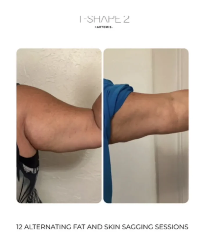 T-Shape 2 upper arm before and after twelve alternating fat and skin sagging sessions showing a slimmer arm.