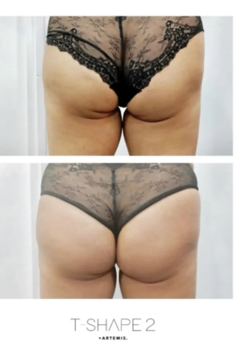 T-Shape 2 before and after showing smoother buttocks with softened dimpling and improved contour.