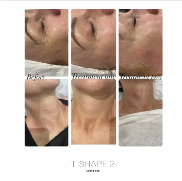 T-Shape 2 progression across two treatments showing softened crow's feet and smoother neck lines.