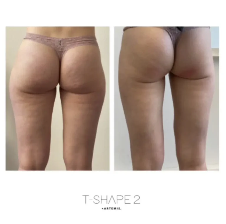 T-Shape 2 rear view before and after with smoother glutes and thighs and reduced surface dimpling.