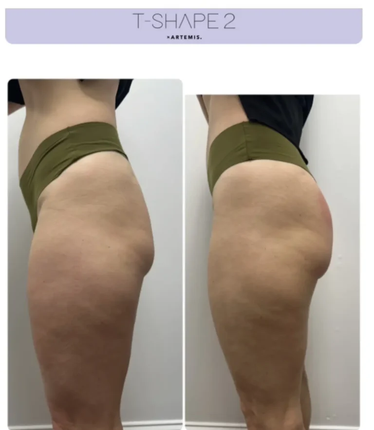 T-Shape 2 side profile before and after showing a firmer, more lifted hip and thigh contour.