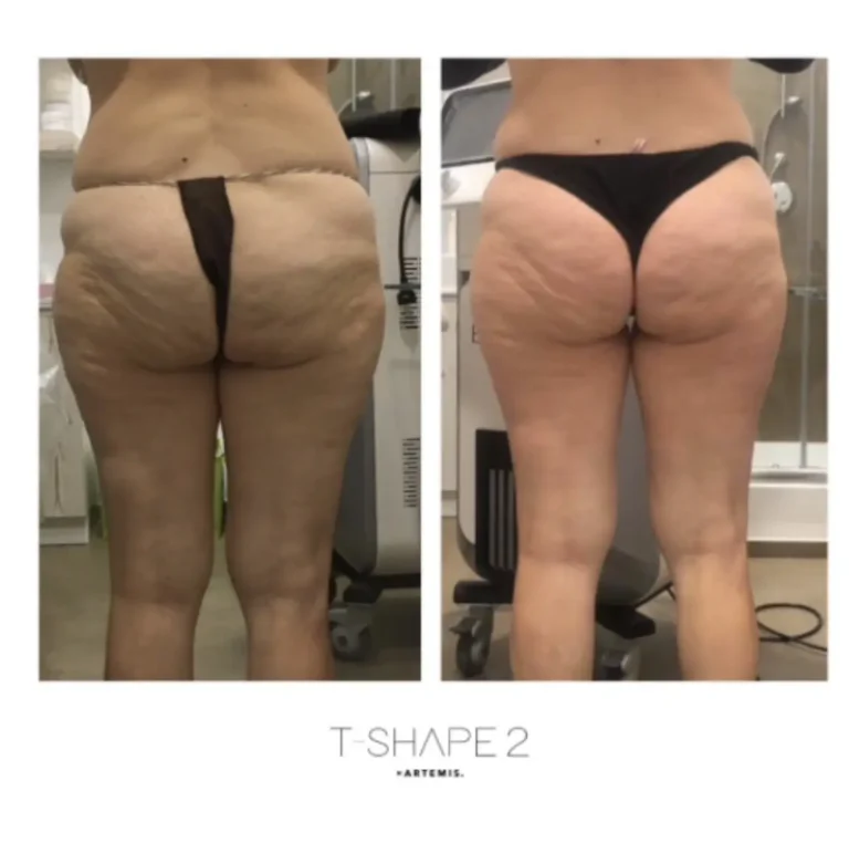 T-Shape 2 before and after showing visibly smoother thighs and buttocks with reduced cellulite texture.