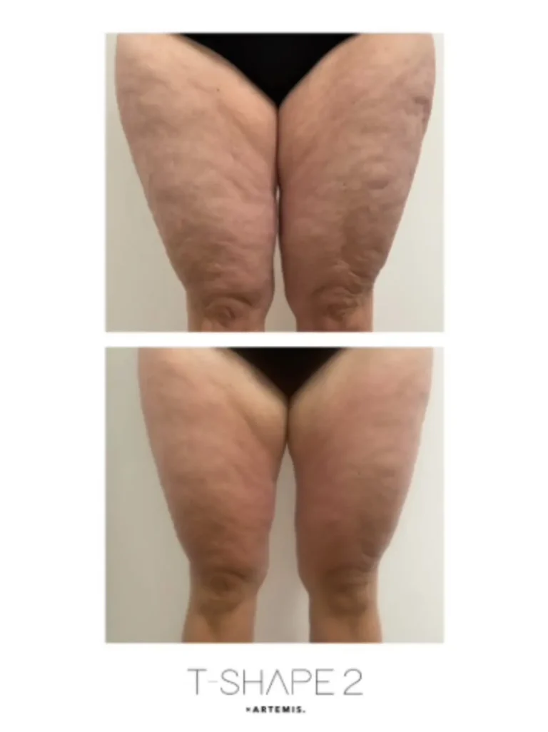 T-Shape 2 before and after showing markedly smoother thigh skin with reduced rippling and dimpling.