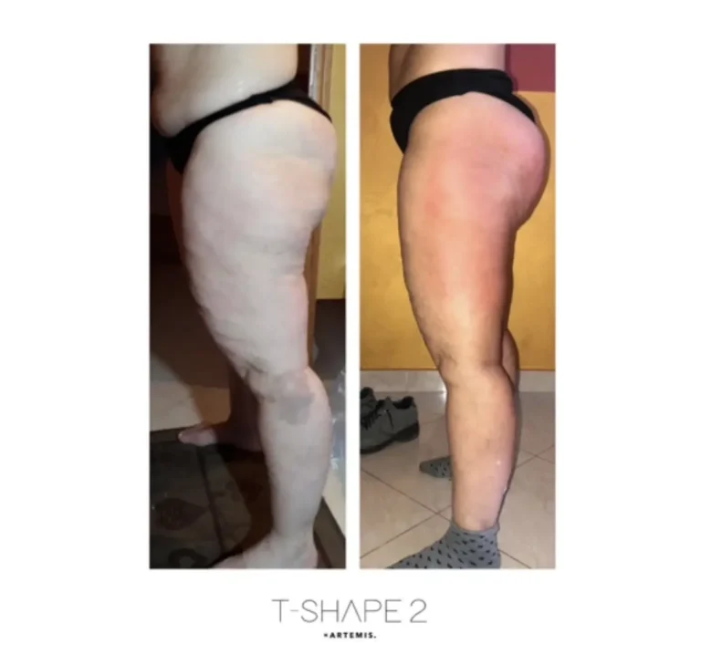 Side profile before and after T-Shape 2 showing a smoother thigh contour with less visible cellulite.