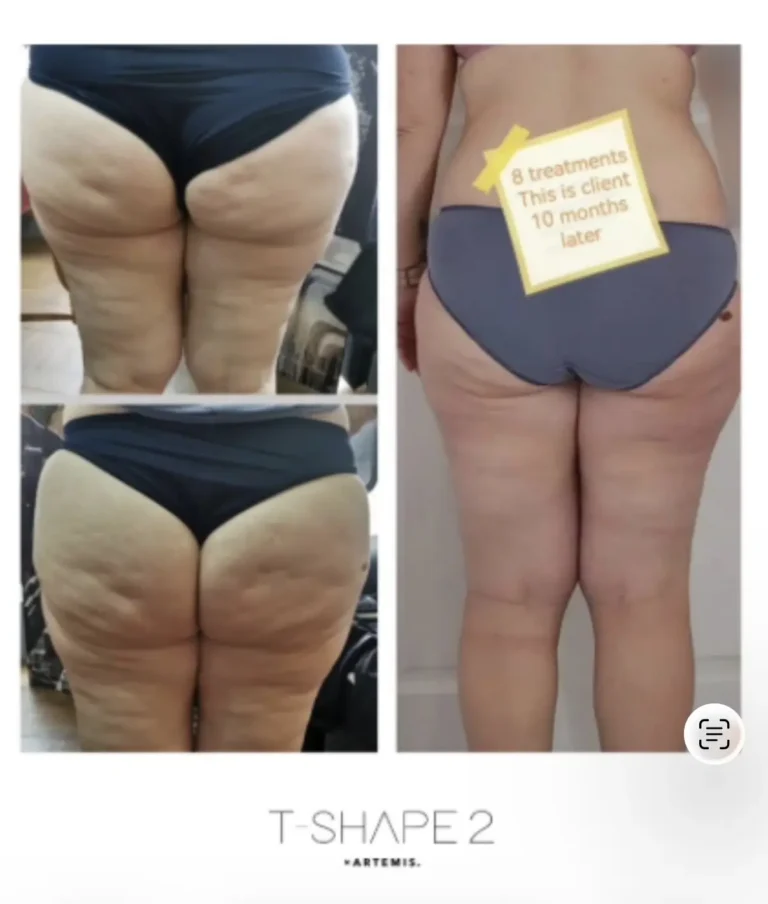 T-Shape 2 results after eight treatments, shown ten months later with lasting thigh and glute smoothing.