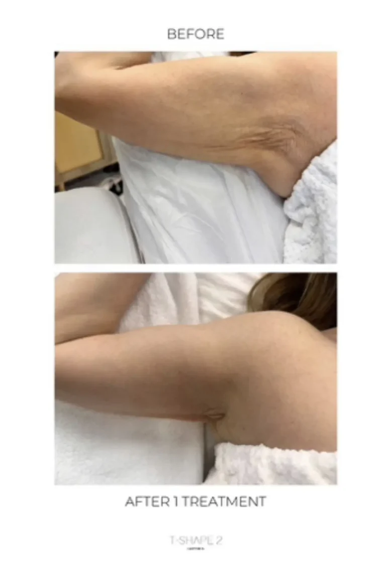 T-Shape 2 before and after one treatment showing firmer upper arm skin with reduced crepey texture.